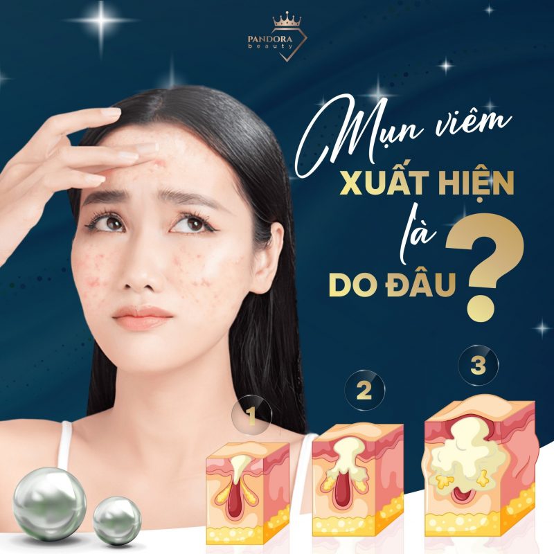 Mụn viêm