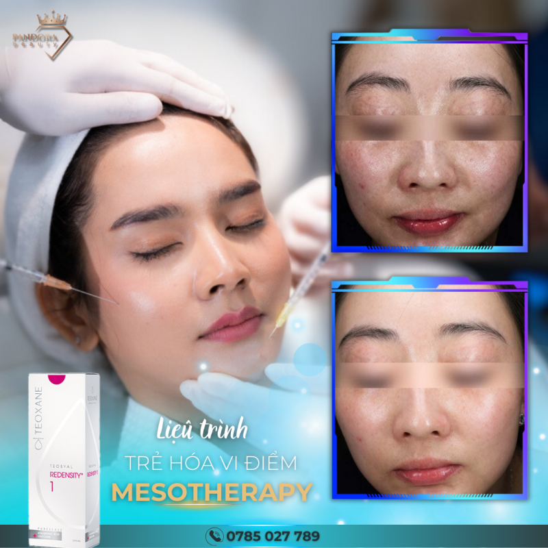 Mesotherapy Thuy Sy