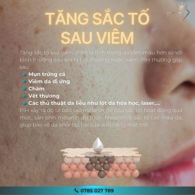 Tăng sắc tố sau viêm là gì?