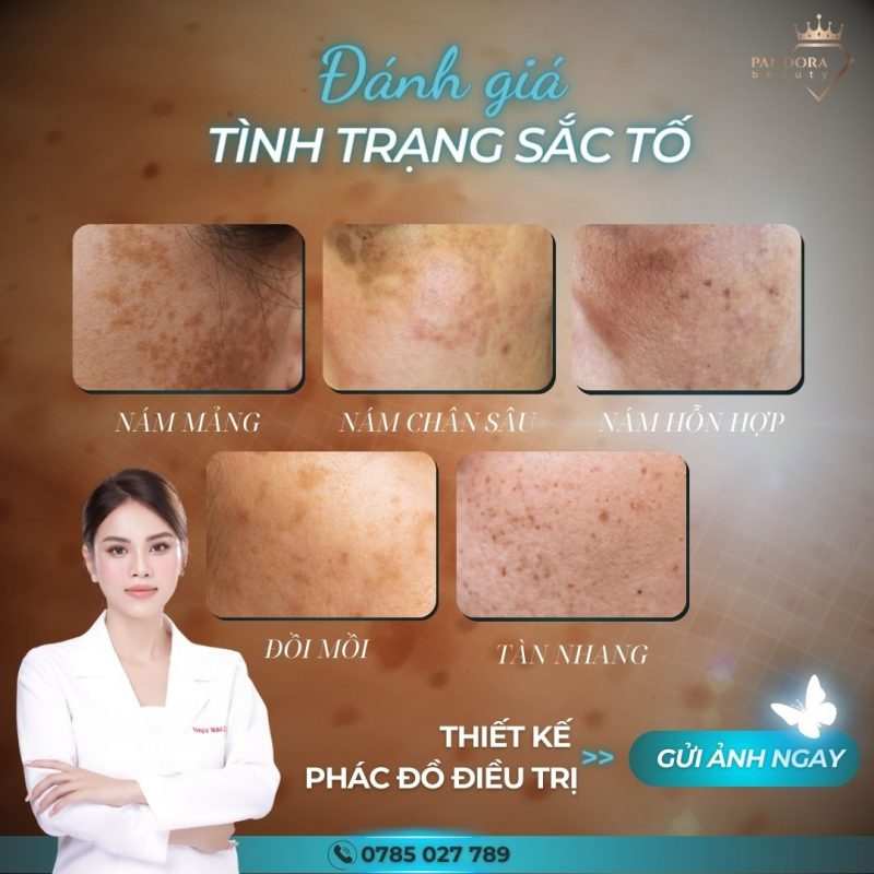 Điều Trị Nám Trước Tiên Phải Phân Loại Nám Và Nguyên Nhân