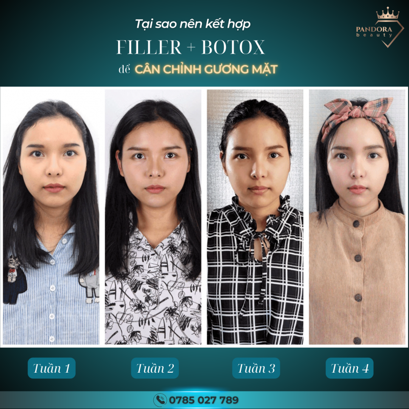 Liệu trình kết hợp Botox Filler Hoàn Hảo