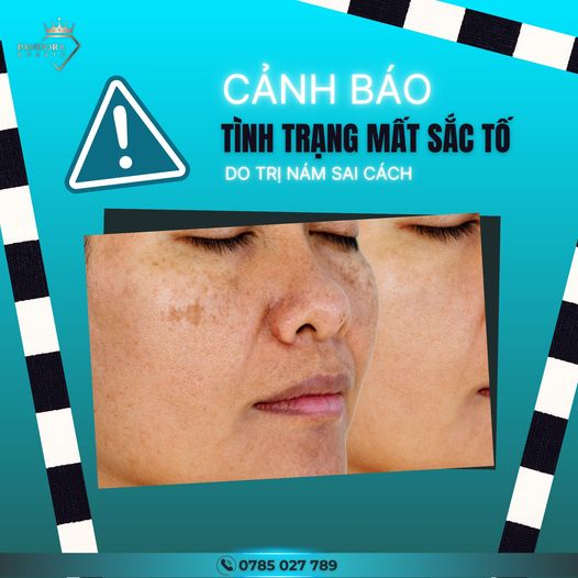 Mất sắc tố da sau Laser - Hãy cẩn thận!!